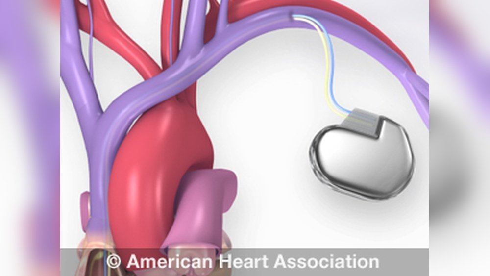 Can A Cordless Drill Interfere With A Pacemaker? Essential Facts